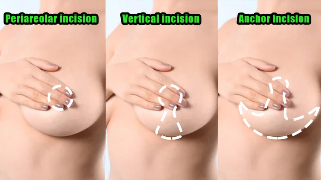 What-are-the-different-types-of-incisions-used-in-a-breast-lift-procedure