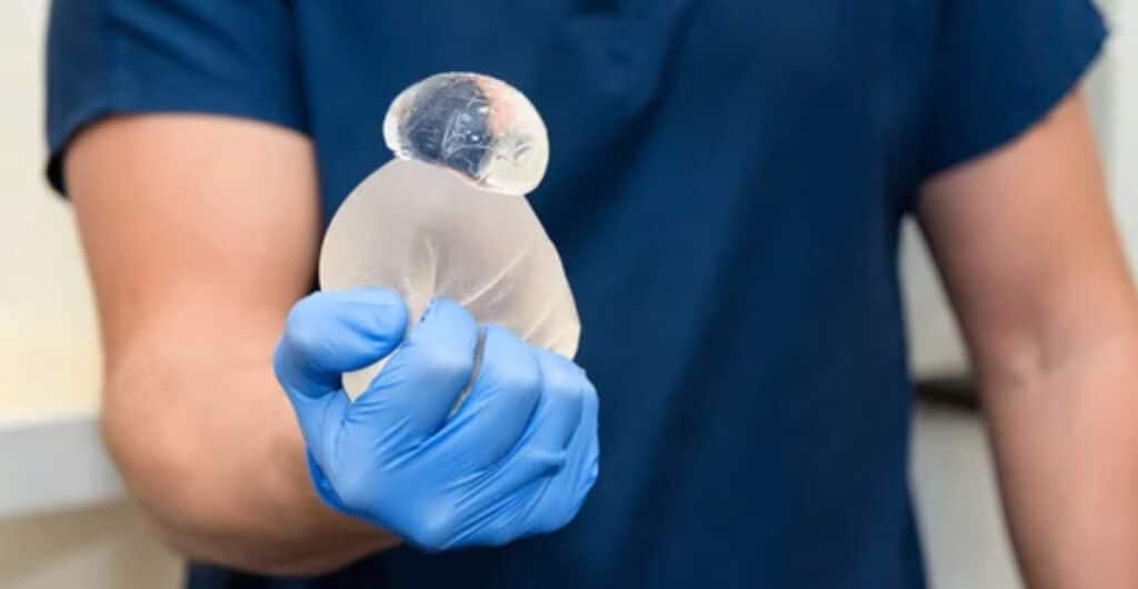 What are the factors that can affect the Lifespan of Breast Implants?