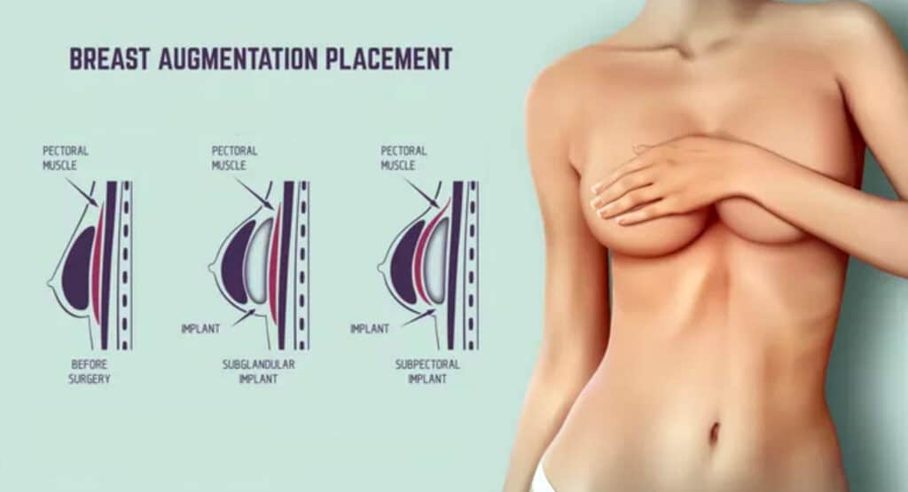 Why getting breast augmentation? Breast augmentation is a cosmetic surgery