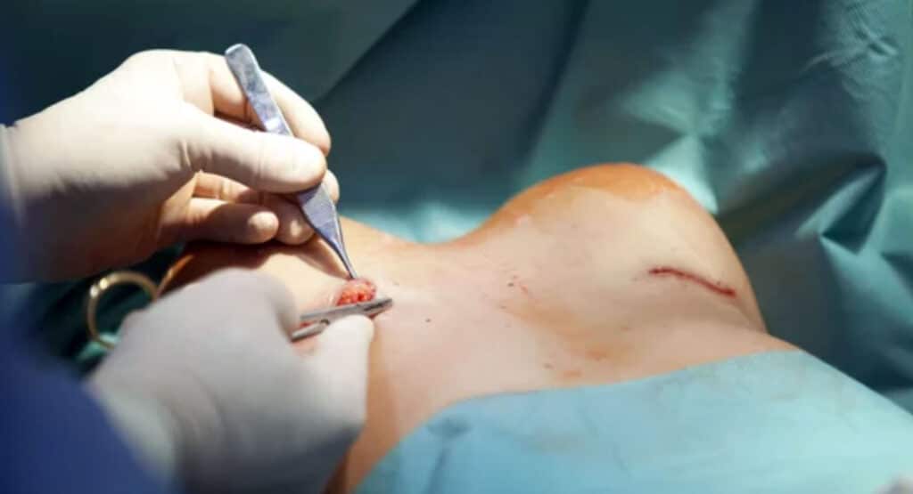 breast augmentation surgery in the operating room surgeon tools implant
