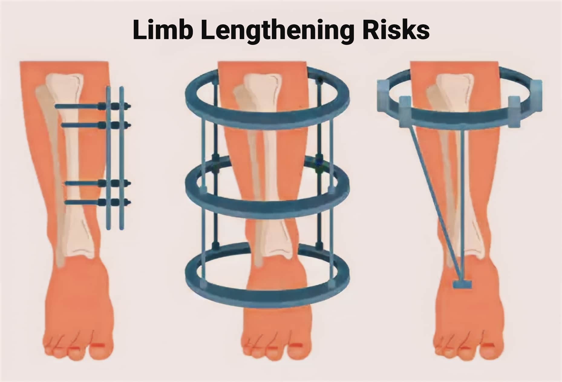 7-Shocking-Limb-Lengthening-Risks--Unveiling-the-Hidden-Dangers-of-This-Life-Changing-Surgery