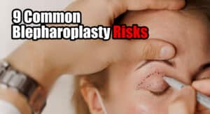 9 Common Blepharoplasty Risks Associated with the Surgery