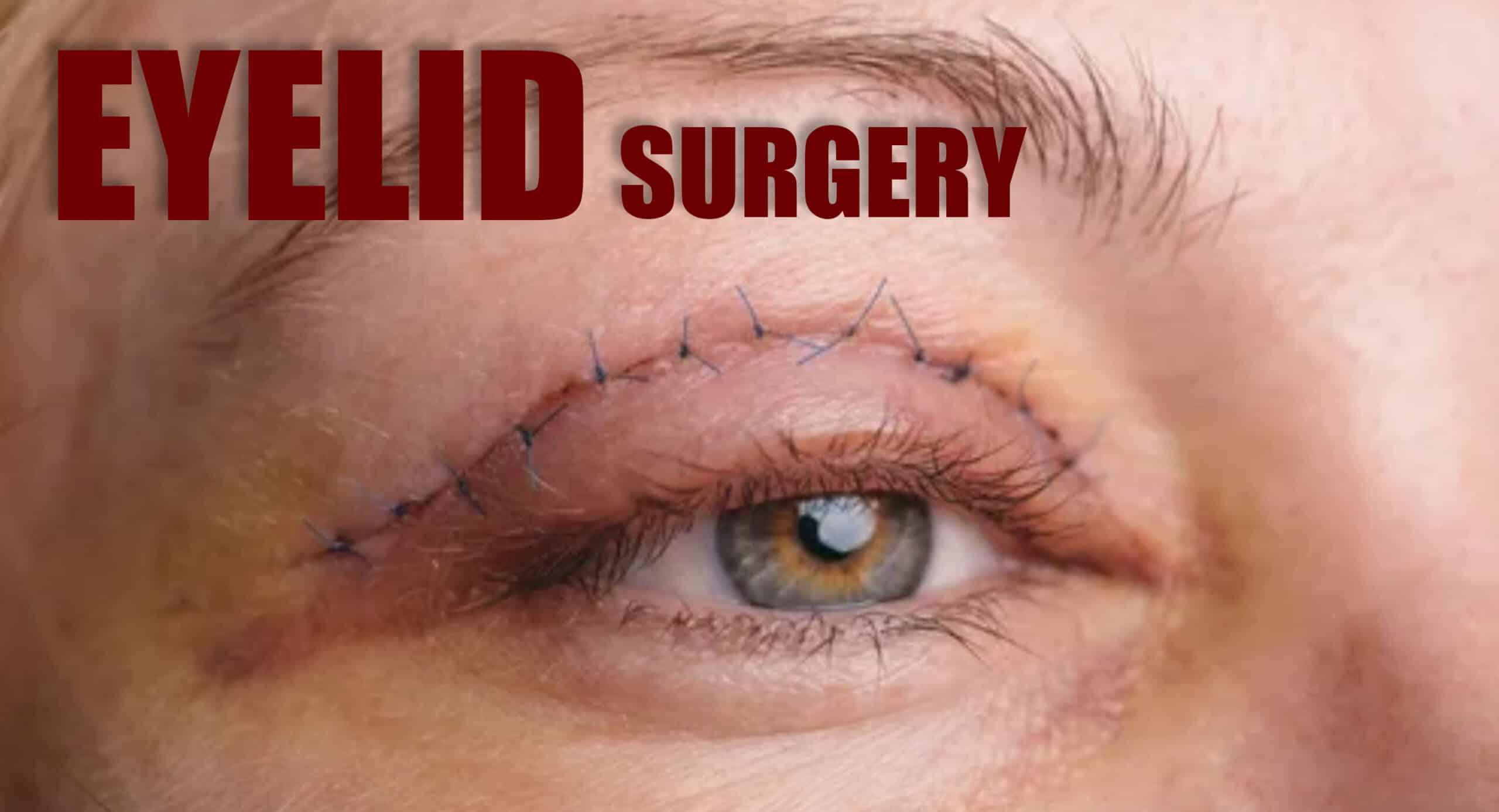 Blepharoplasty Understanding the Procedure, Recovery, and Benefits