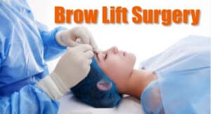 Brow Lift Everything You Need to Know About the Procedure, Recovery, and Risks