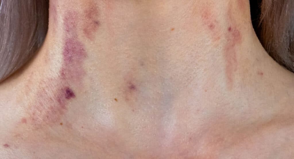 Bruising after neck lipo