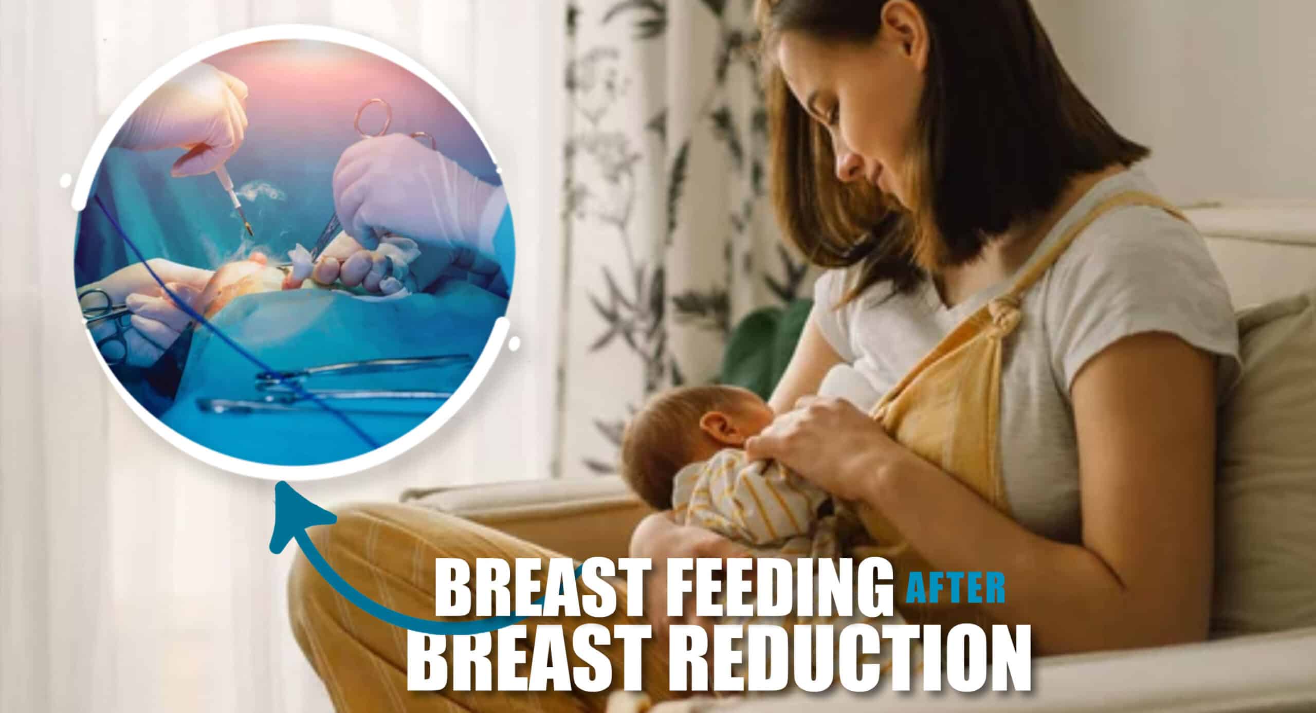 How Does Breast Reduction Surgery Affect Breastfeeding, and What Should Women Who Plan to Have Children in the Future Know About This?