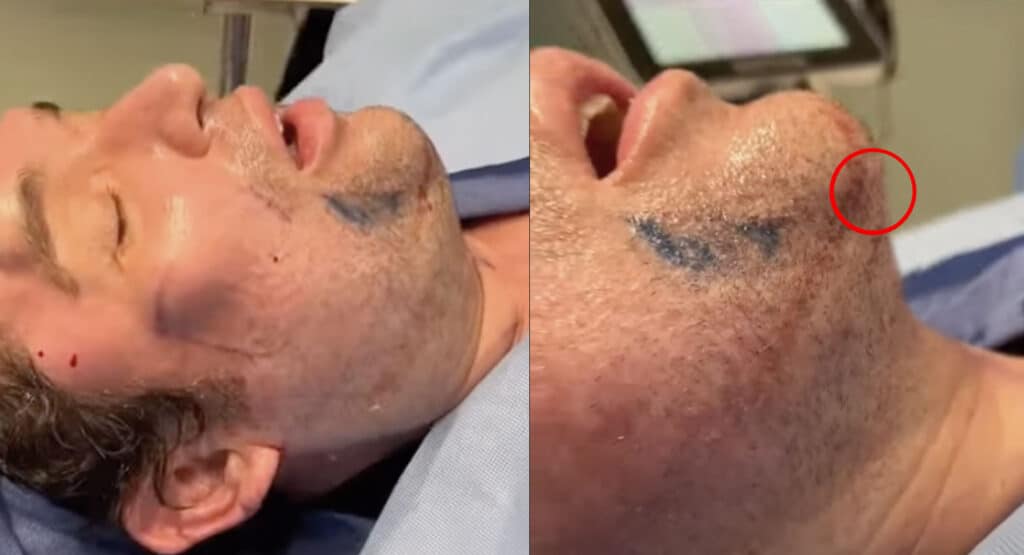 Scarring after neck lipo