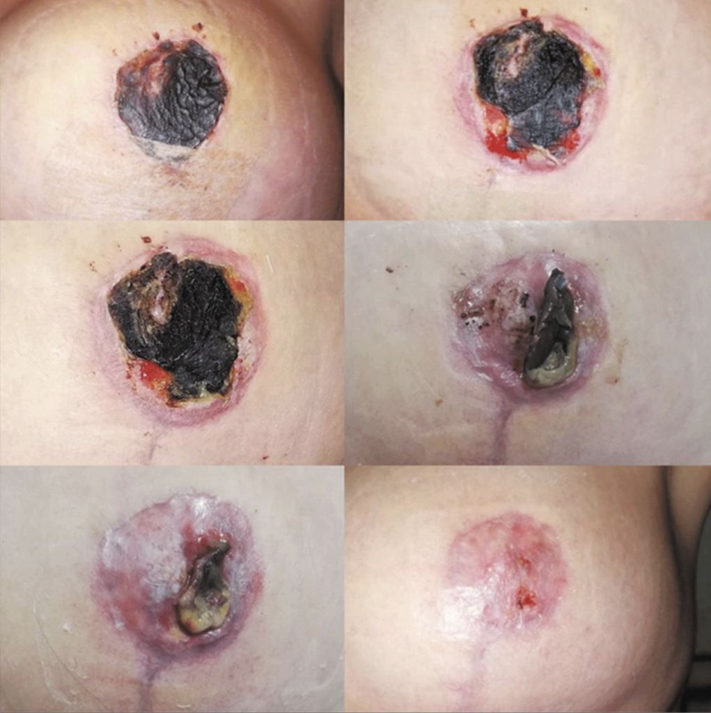 Symptoms of Necrosis in Breast Reduction: