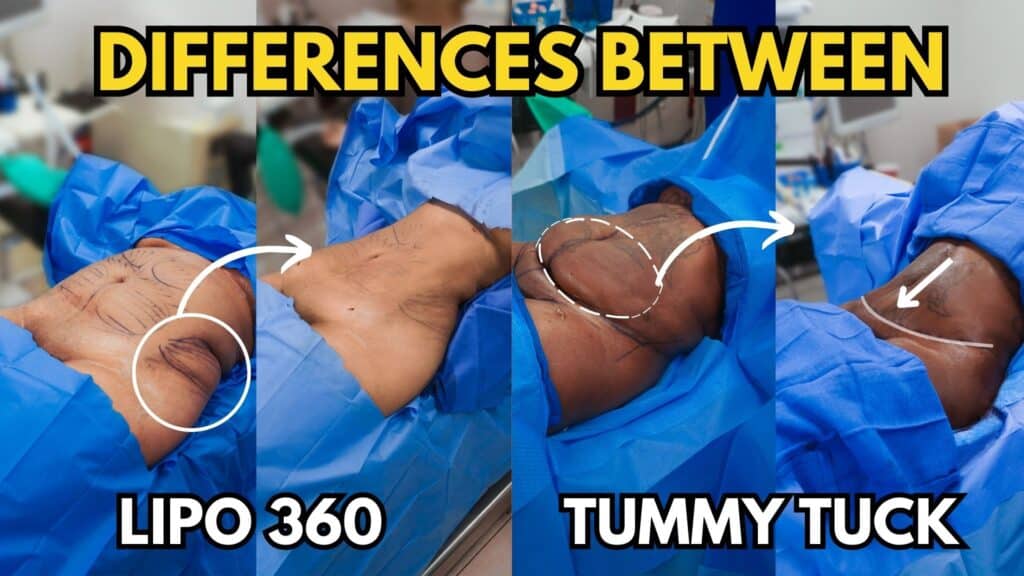 What is the difference between a lipo 360 vs tummy tuck?