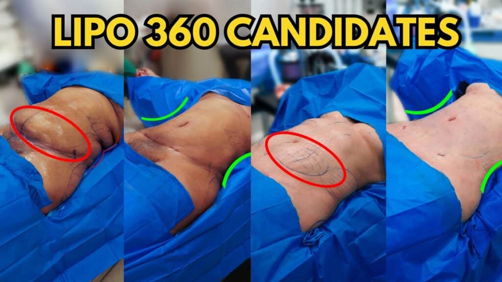 Who is a good candidate for a lipo 360?