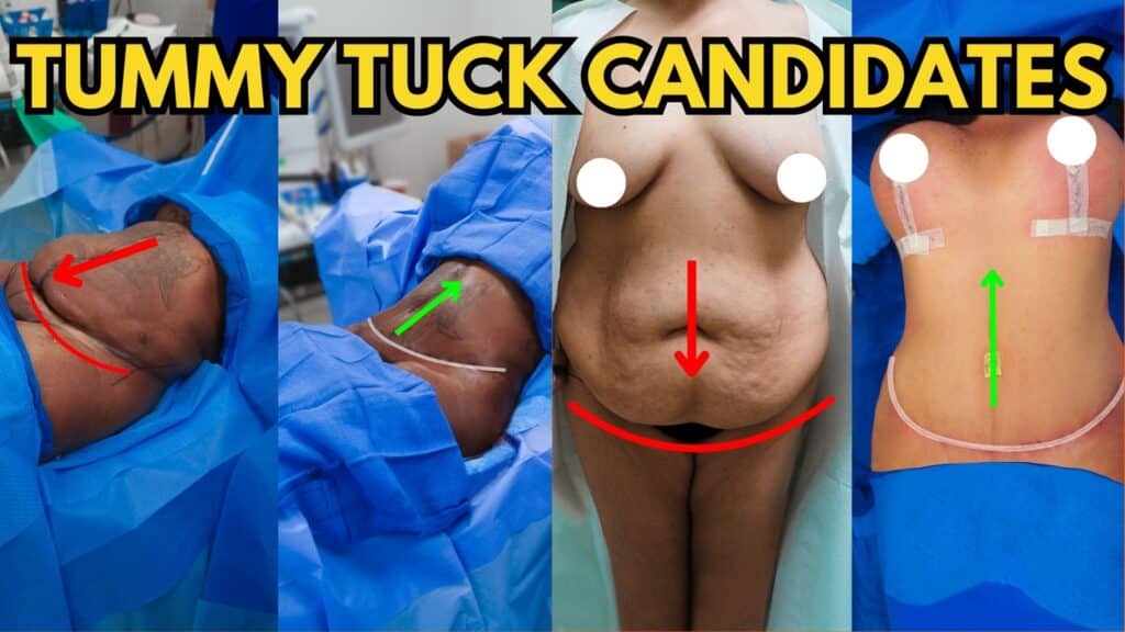 Who is a good candidate for a tummy tuck?