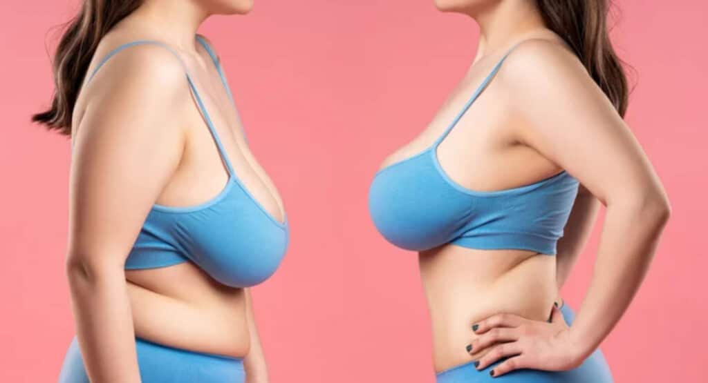 Will my breasts still sag after the surgery, or will they be lifted?