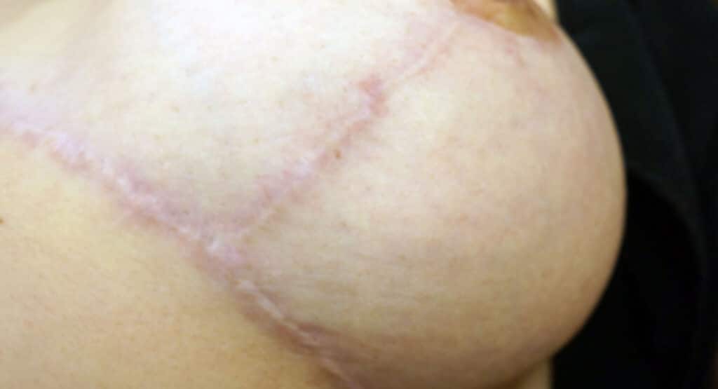 breast reduction scar