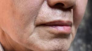 Facelift-for-Wrinkles-Sagging-skin-and-Jowls