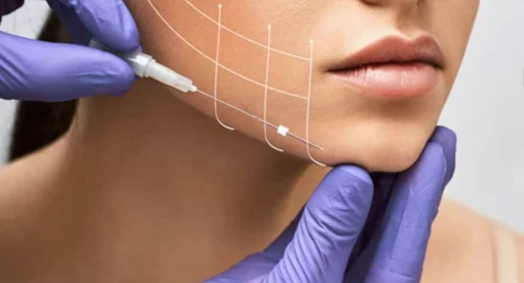 Facial lifting thread. Thread facelift with arrows on face for woman's skin, procedure facial contouring using mesothreads
