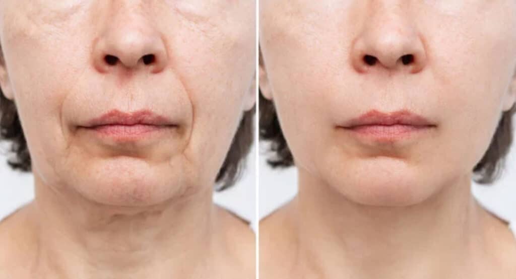 Lower part of face and neck of elderly woman with signs of skin aging before after facelift, plastic surgery on white background. Age-related changes, flabby sagging skin, wrinkles, creases, puffiness