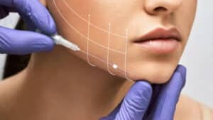 facelift-surgery