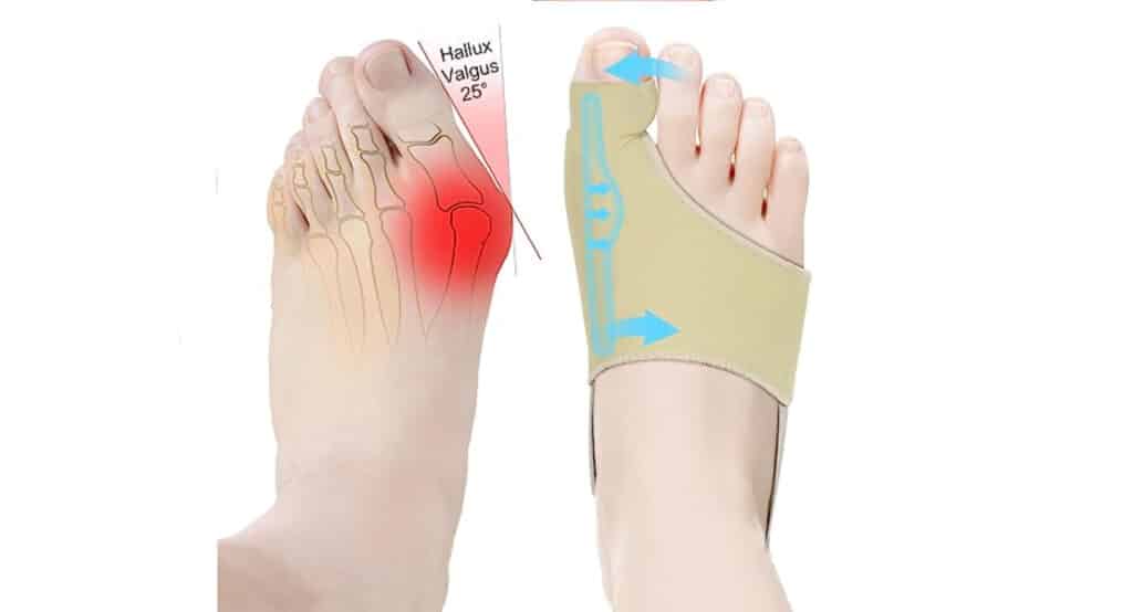 Orthopedic Toe Straightener